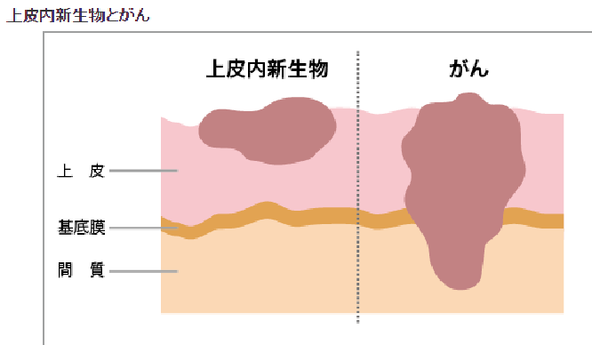 上皮内がん